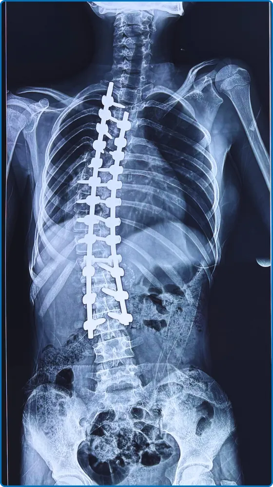 Case 1 · Scoliosis — After correction