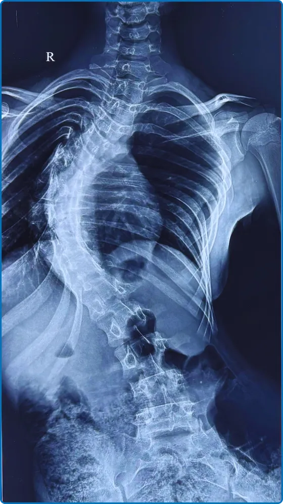Case 1 · Scoliosis — Before surgery